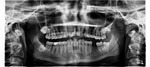 x ray teeth tooth is missing stock photo